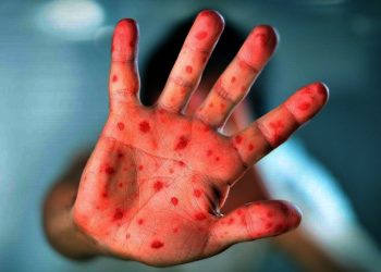 El Sedes La Paz activa vigilancia y moviliza personal, ante alerta por sarampión