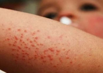 Sarampión vuelve por descuido de los padres, según viceministro de Vigilancia Epidemiológica
