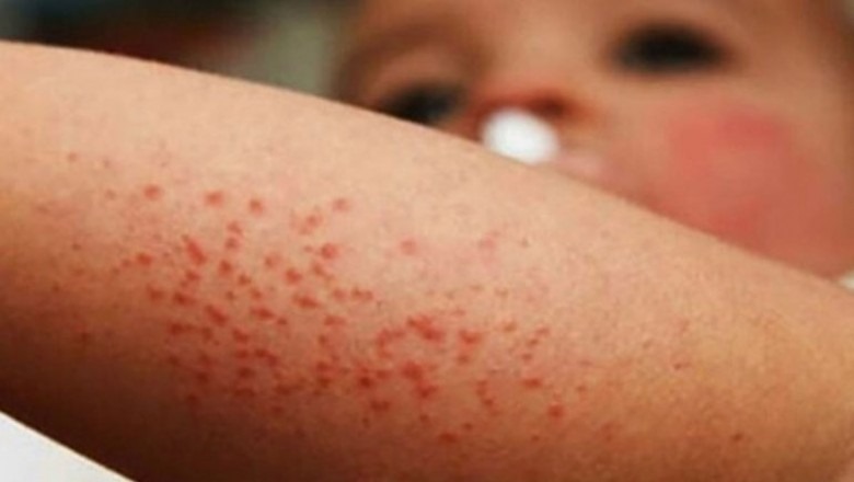 Sarampión vuelve por descuido de los padres, según viceministro de Vigilancia Epidemiológica