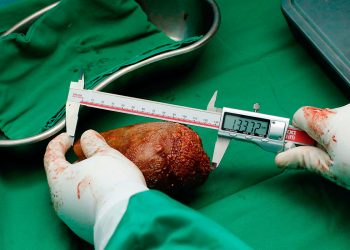 calculo_renal-en_sri_lanka.jpg