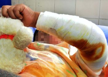 Un niño queda con el 50% del cuerpo quemado tras un juego con alcohol y fósforos