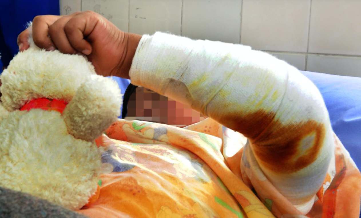 Un niño queda con el 50% del cuerpo quemado tras un juego con alcohol y fósforos