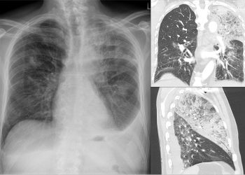 Enfermedad del legionario. Vista de cómo afecta al sistema respiratorio.