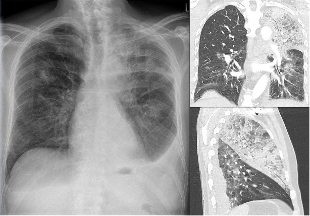 Enfermedad del legionario. Vista de cómo afecta al sistema respiratorio.