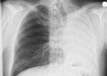 Imagen referencial de enfermedades respiratorias en Chile