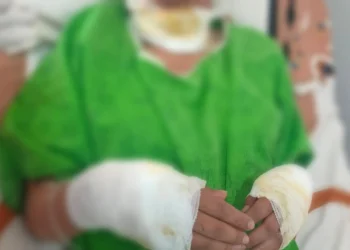 La adolescente atacada por sus padres tiene quemaduras de primer y segundo grado. FOTO: Fiscalía de Oruro